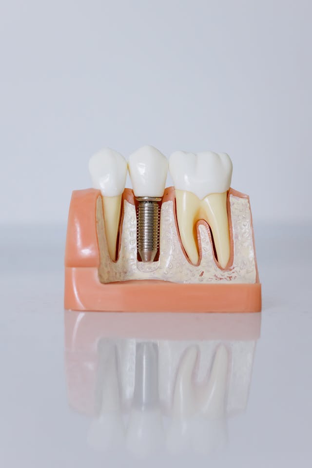 Does Dental Insurance Cover Implants